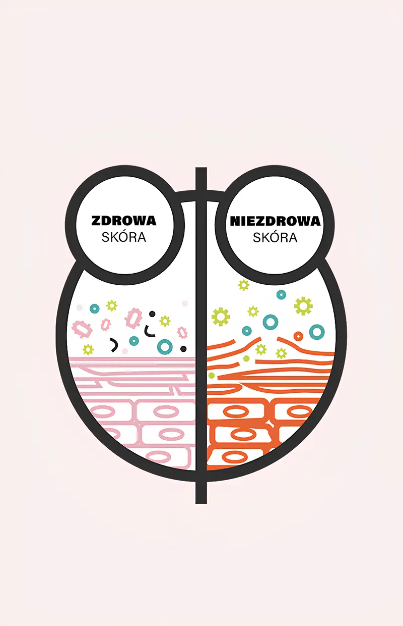 Ilustracja pokazująca r&oacute;żnicę między zdrową a niezdrową sk&oacute;rą.