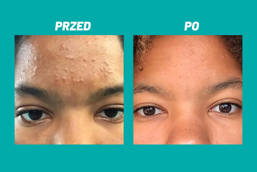 Przed i po zastosowaniu kosmetyku Yun na twarzy z niedoskonałościami.