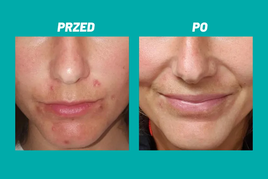 Przed i po zastosowaniu kosmetyku Yun na twarzy z niedoskonałościami.